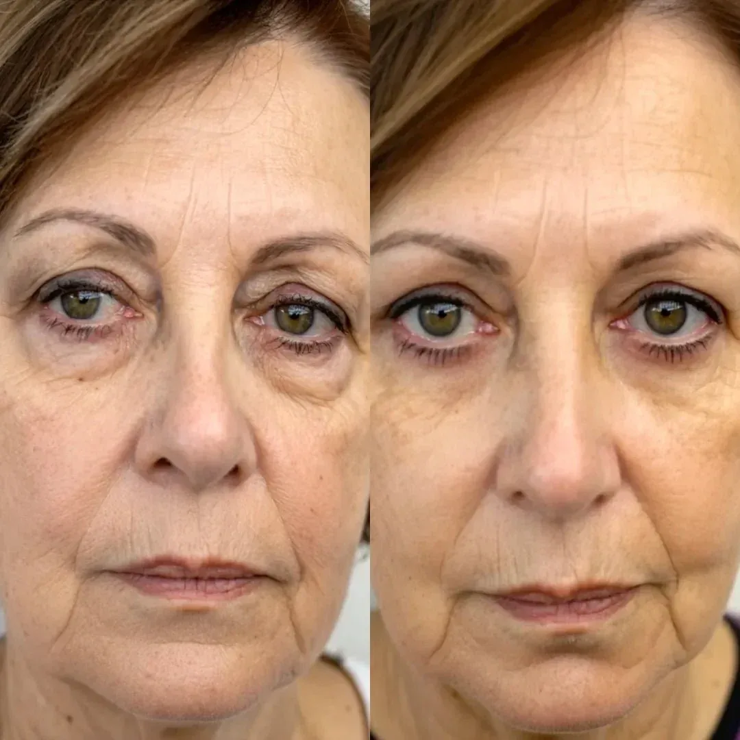Under-eye area before and after daily use